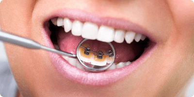 Lingual Braces