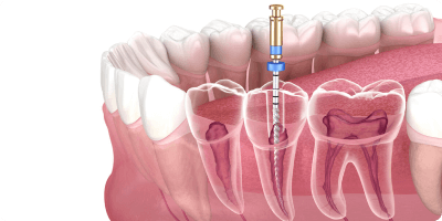 Apical Surgery