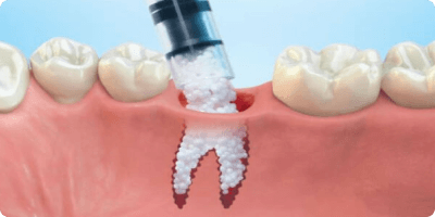 Bone Grafting