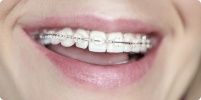 Clear (Ceramic) Braces