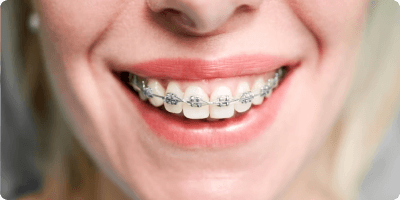 Metal Braces