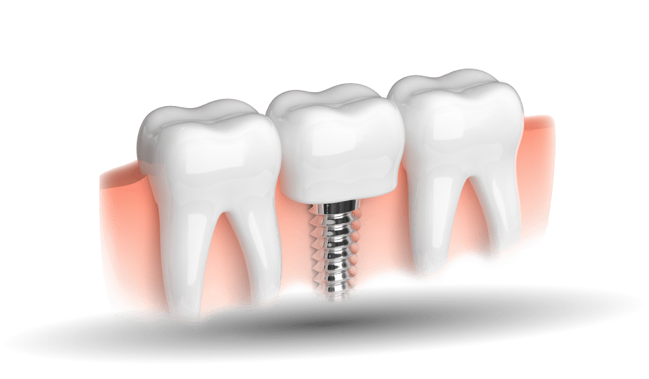 Dental Implants