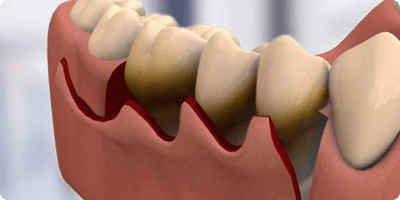 Periodontal Flap Surgery