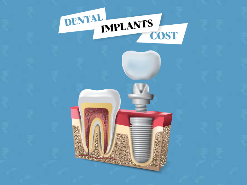 Dental Implants Cost: Factors and Breakdown