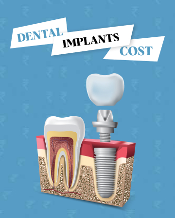 Dental Implants Cost