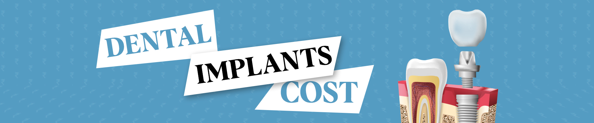 Dental Implants Cost