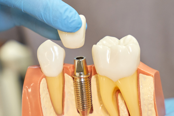 What is Dental Implants