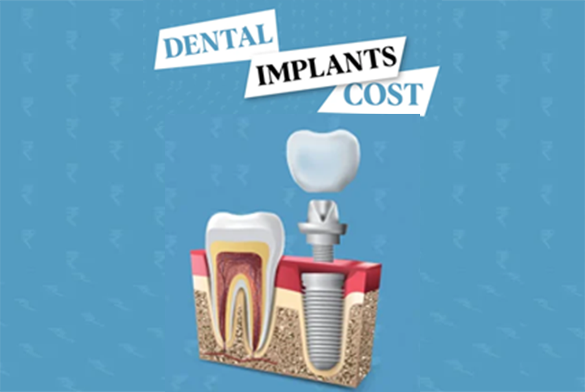 Dental implants cost