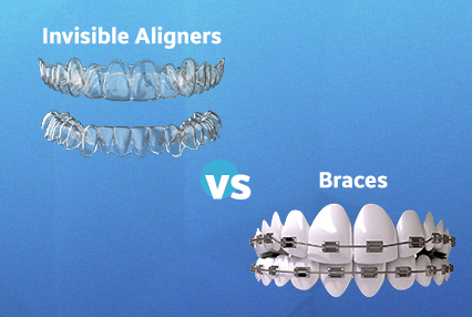 Invisible Aligners