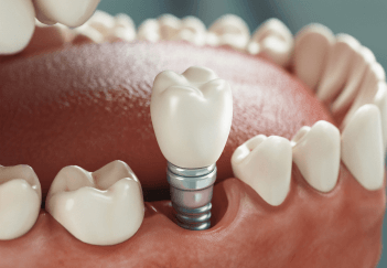 Dental Implants