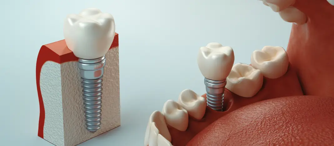 Best Dental Implants