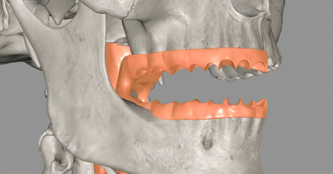 dental implants types