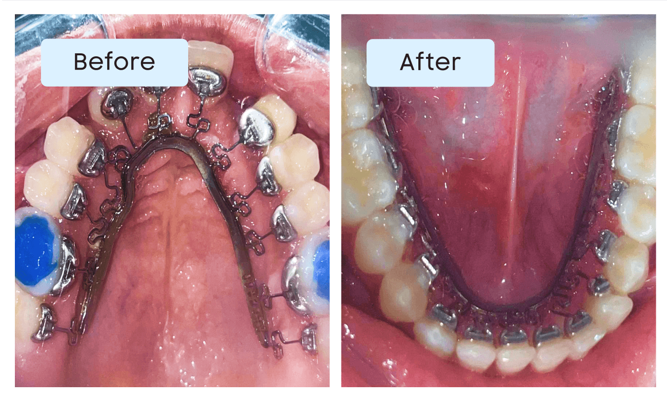 Braces Treatment