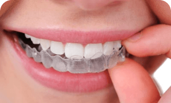 Invisible aligners 