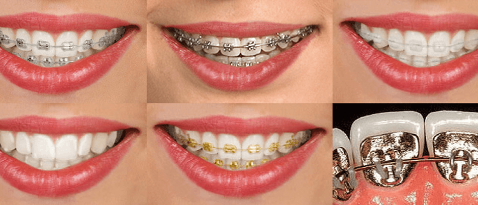 Benefits of teeth braces