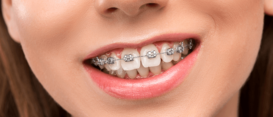 What are Conventional Metal Braces