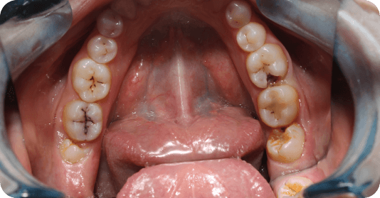 Tooth Decay - Causes of Toothache
