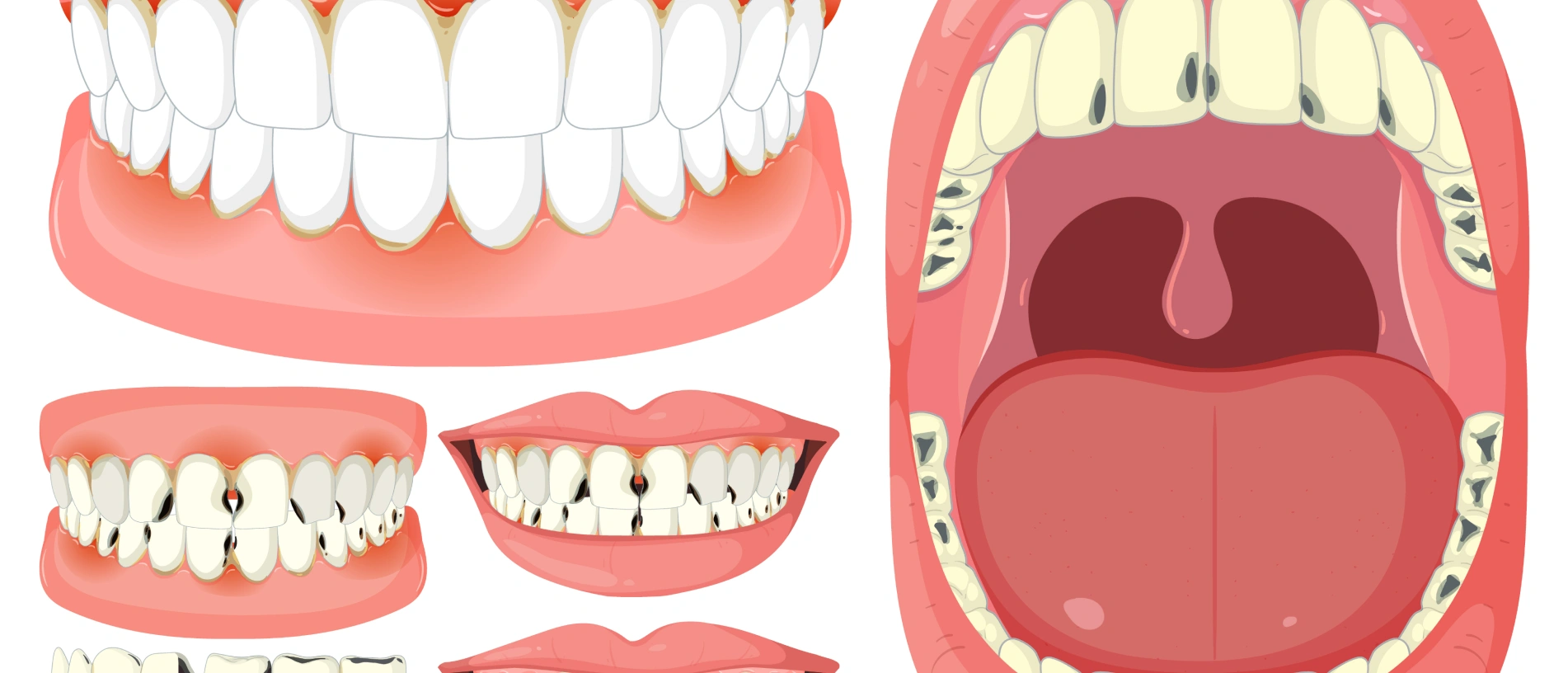 Illustration of removable dentures on upper and lower jaws
