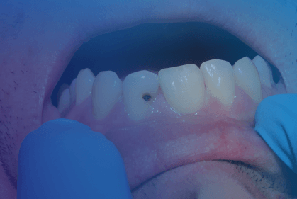 cavity on front teeth