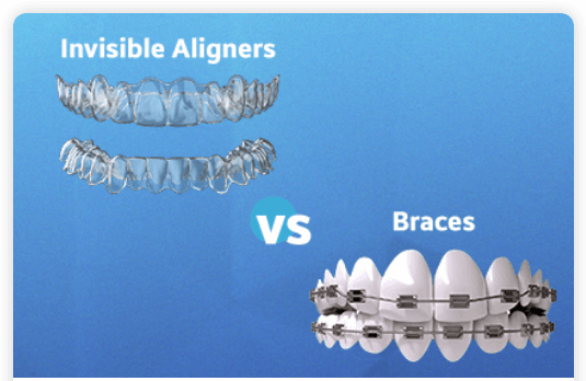 Teeth Braces vs Invisalign