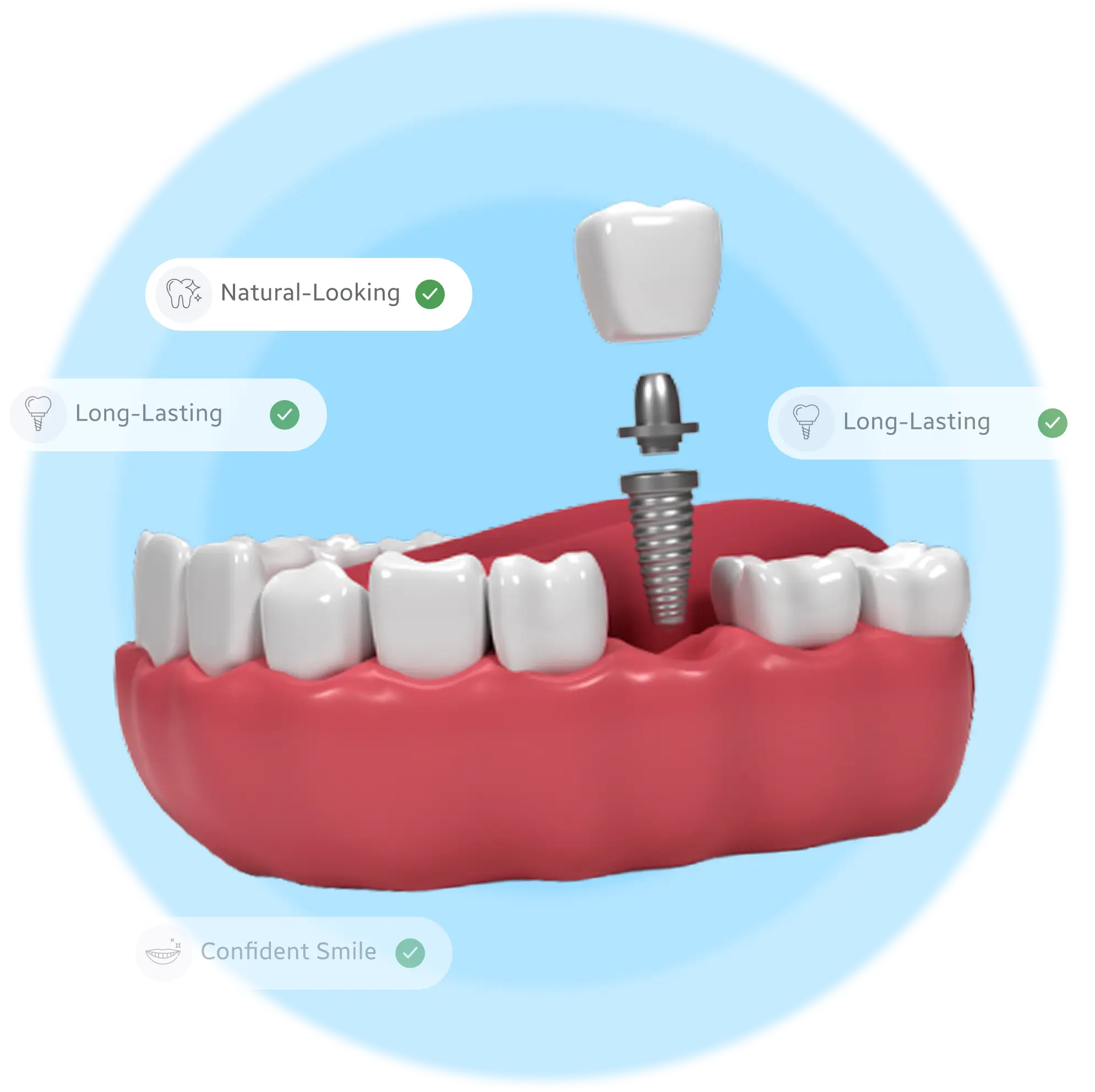 dental implants in bangalore