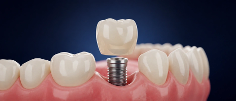 dental implant lifespan