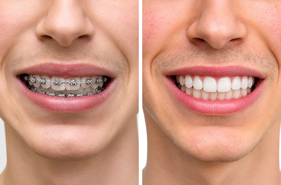 braces for teeth in Bangalore before and after