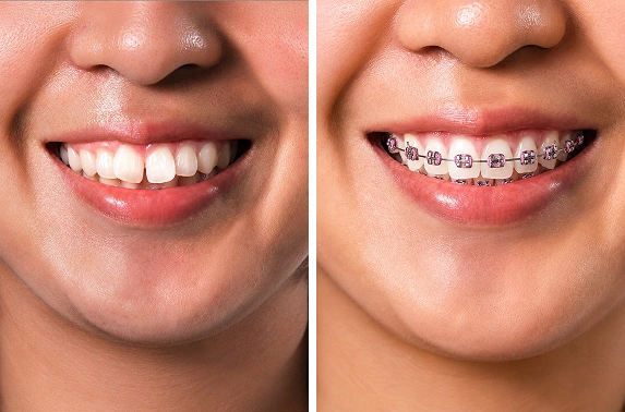 braces for teeth in Bangalore before and after