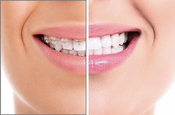 braces for teeth in Bangalore before and after