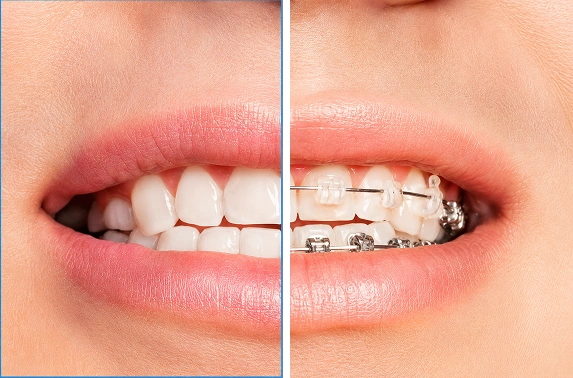 braces for teeth in Bangalore before and after