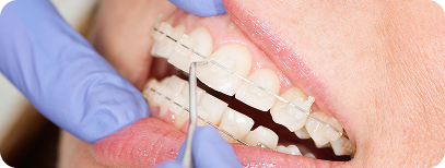 Ceramic braces for teeth straightening treatment