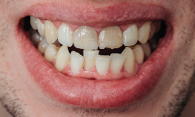 Close-up of crooked and misaligned teeth