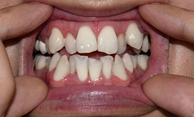 Close-up of crowded teeth being examined