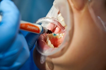 Image for dental sealants applied to children's molars