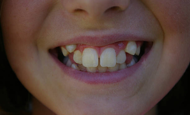 Close-up of a child's smile showing overbite issues