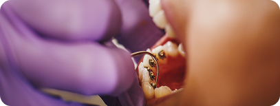 Lingual braces for teeth straightening treatment