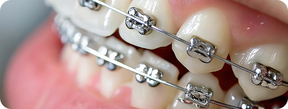 Metal braces for teeth straightening procedure