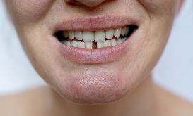 Close-up of a gap between front teeth