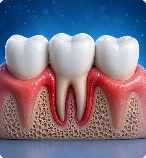 Illustration of gum disease affecting teeth and gums