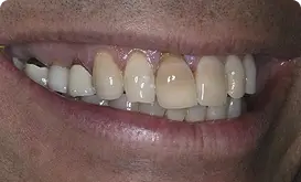 Image showing loose teeth or bite alignment changes