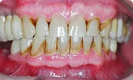 Image showing pus formation between gums and teeth