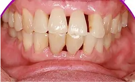 Image showing loss of gum tissue around teeth