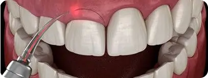 Dentist performing deep cleaning below the gum line