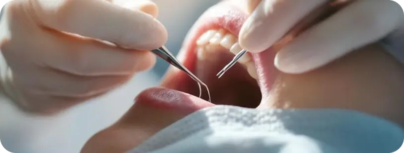 Dentist placing stitches after gum surgery