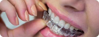 Clear braces for teeth straightening