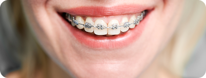 Self-ligating braces for teeth straightening treatment