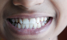 Close-up of a smile with mildly uneven teeth