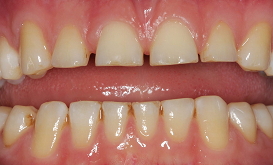 Close-up of teeth showing plaque buildup from crowding
