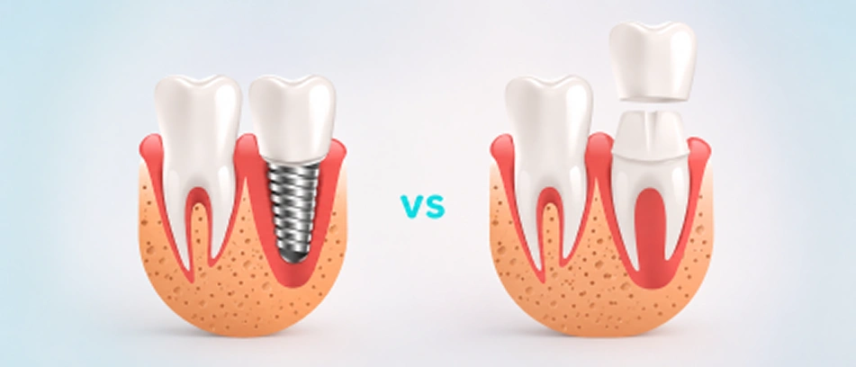 dental implant lifespan