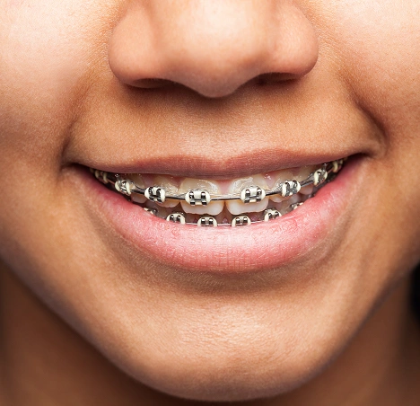 Patient smiling with metal braces on upper and lower teeth